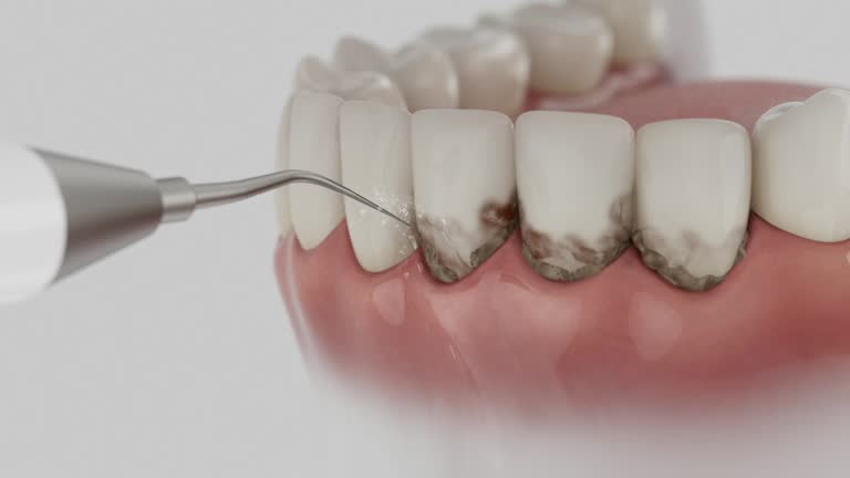 Trusted Wisdom Tooth Removal service in Flagler Estates, FL - Dentist Open Now